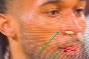 少林功夫🤣卡斯尔嘴唇鼻子被打出血 “凶手”竟是文班……